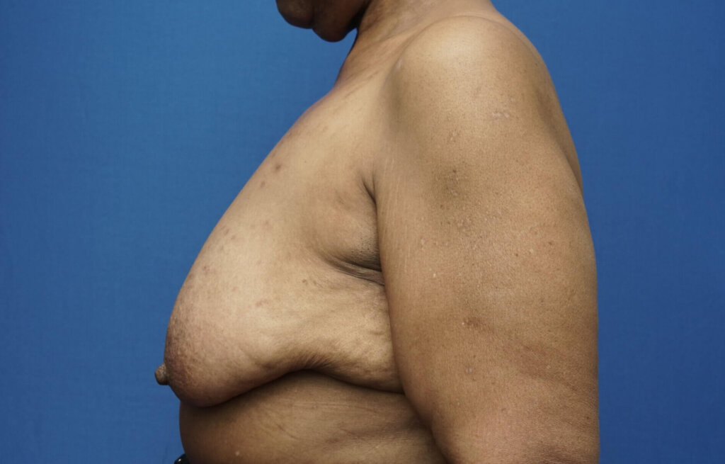 Gynecomastia Surgery: Restoring Confidence for Men with Enlarged Breasts