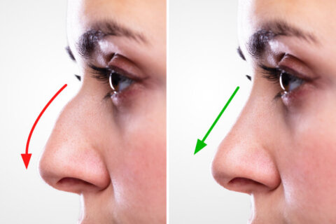 Rhinoplasty in New York – All You Need To Know!