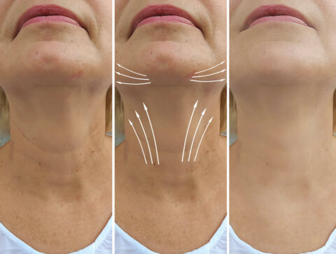 Neck Lift In New York – All You Need To Know!