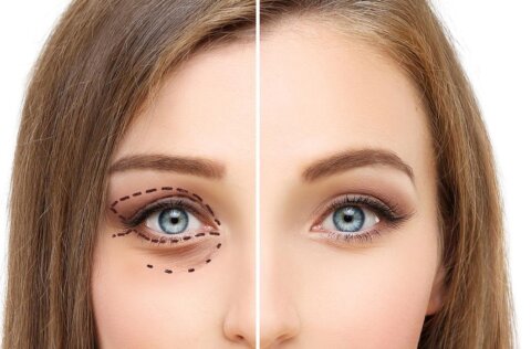 Blepharoplasty In New York – All You Need To Know!