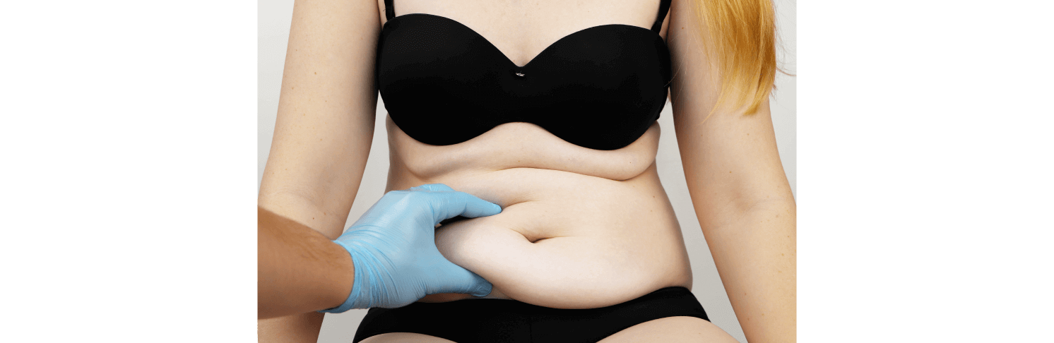 How To Get the Best Tummy Tuck Results (5 Tips From Top Los