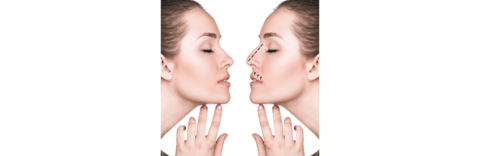 Reasons to consider revision rhinoplasty nyc